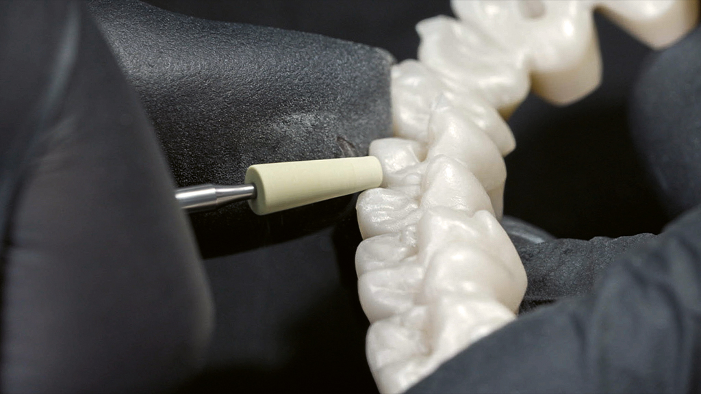 Werkstoffgerechte Bearbeitung von Zirkonoxid im Überblick: Restauration im Weißlingszustand; Ausarbeiten mit Hartmetallfräsern. Die Bearbeitung der gesinterten Brücke mit einem diamantierten Schleifkörper (DCB-Schleifer). Finishing mit einer Etna-Polierscheibe für die Hochglanzpolitur. Mehr dazu in Teil 2 und 3 mit erprobten und konkreten Insider-Tipps.