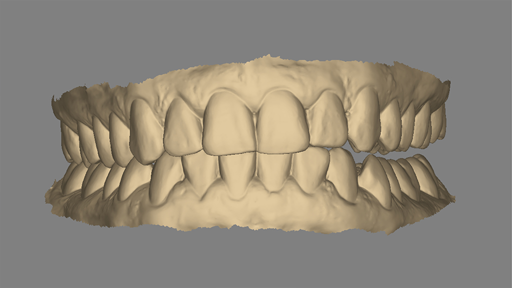 IO-Scan mit Nonokklusion und überzeichneten Kontaktpunkten