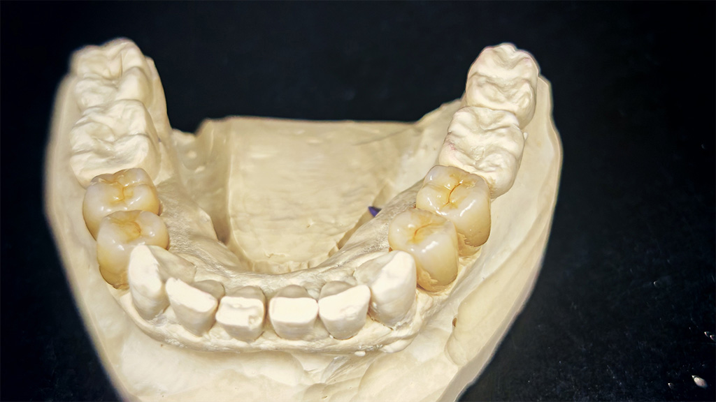 Vollverblendete Krone A3,5 mit HeraCeram Zirkonia 750 aus dem Gerüstmaterial dima Mill Zirconia Shine (Monolayer)